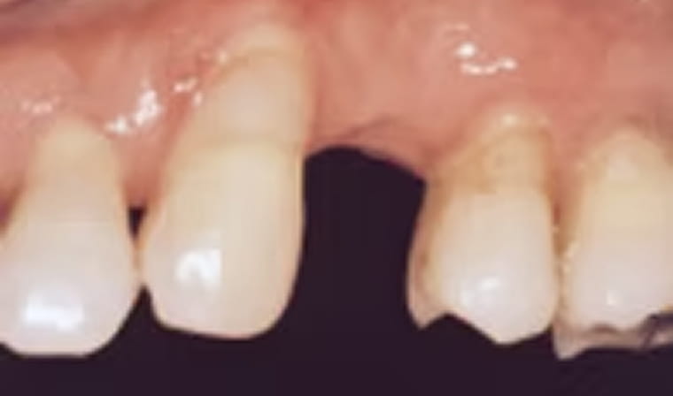 インプラント前