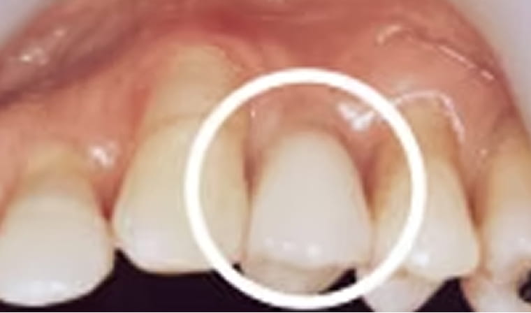 インプラント後