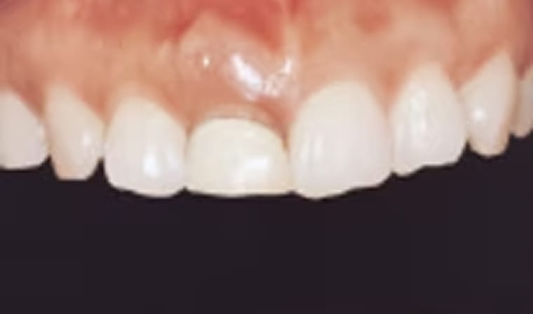 インプラント前