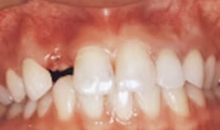 インプラント前