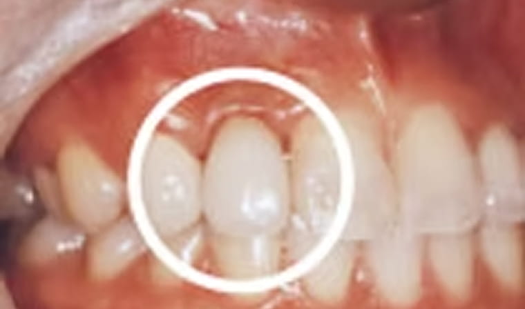 インプラント後