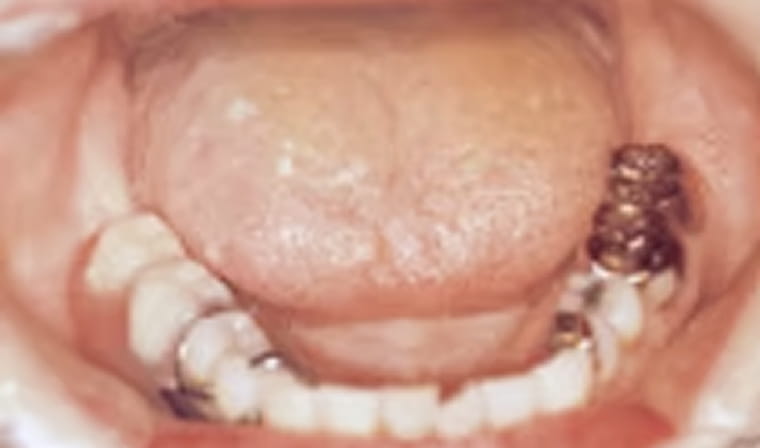 インプラント前