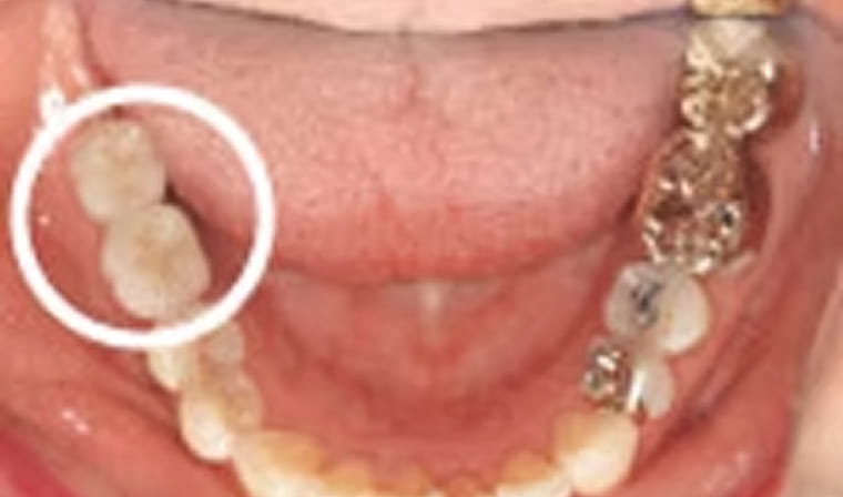 インプラント後