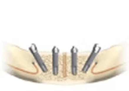 インプラントの手術方法