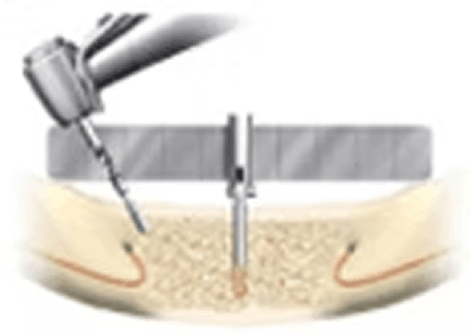 インプラントの手術方法