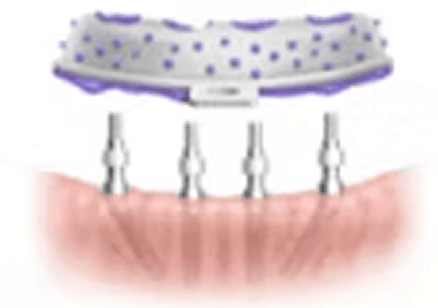 インプラントの手術方法