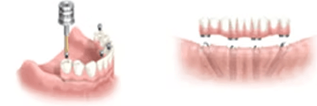 インプラントの手術方法
