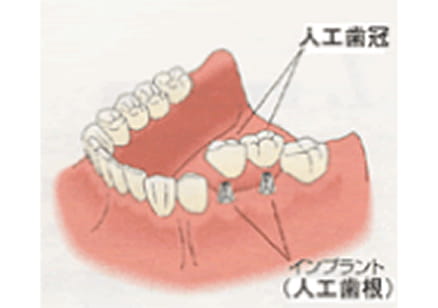 インプラントの治療方法