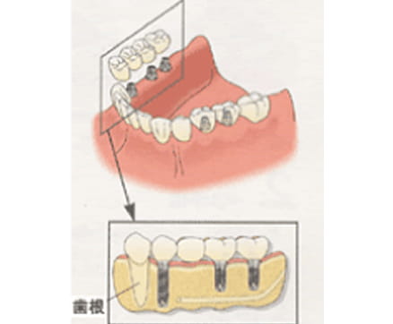 インプラントの治療方法
