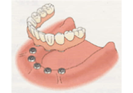 インプラントの治療方法