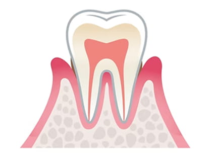歯周病