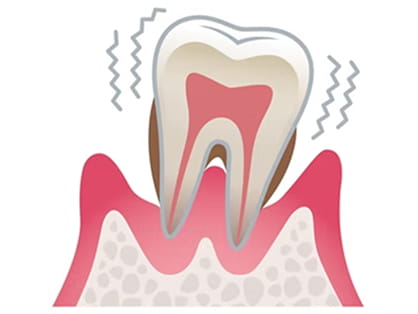 歯周病