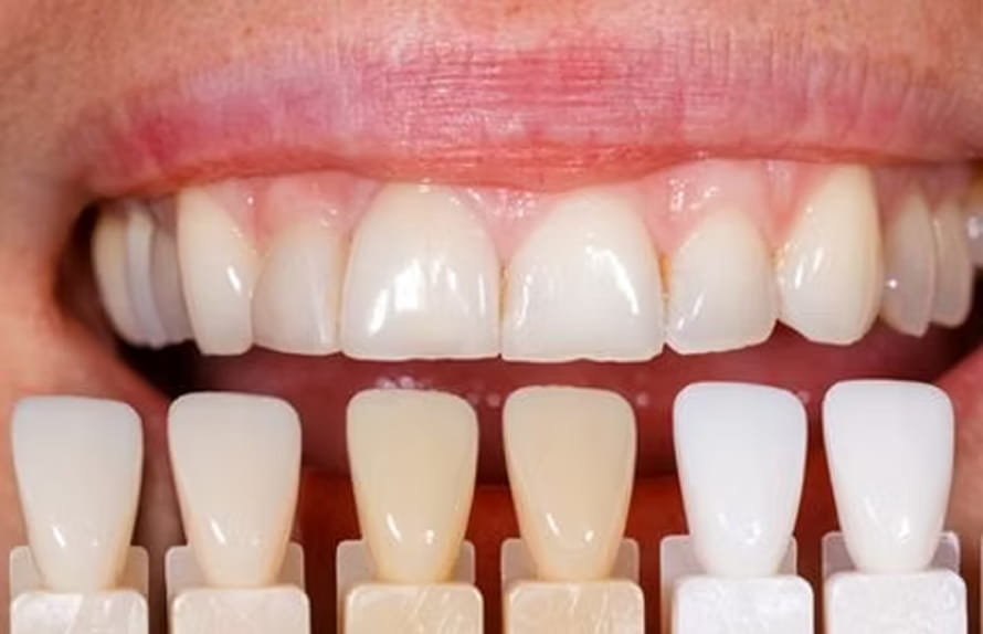 セラミックの歯